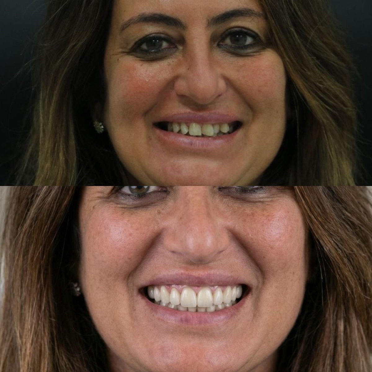 نتيجة قبل وبعد زراعة الأسنان All-on-6 في Excelentis Dental Center، استعادة الابتسامة