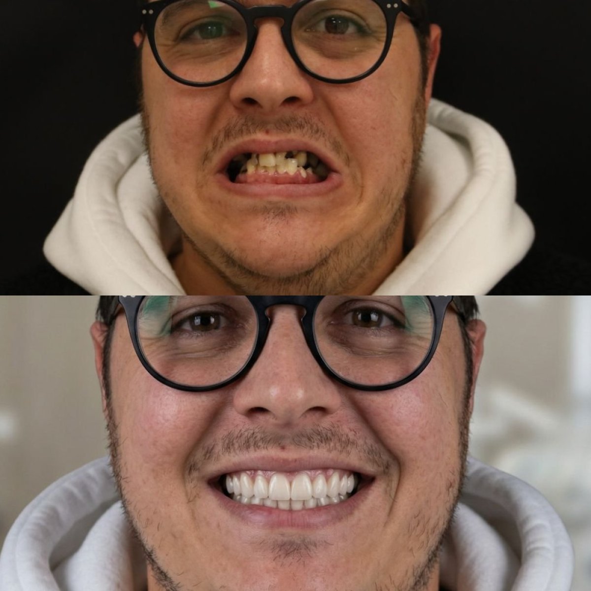 نتيجة قبل وبعد زراعة الأسنان All-on-6 في Excelentis Dental Center، ابتسامة محسنة