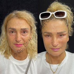 Premium Facelift All Included - photo 4