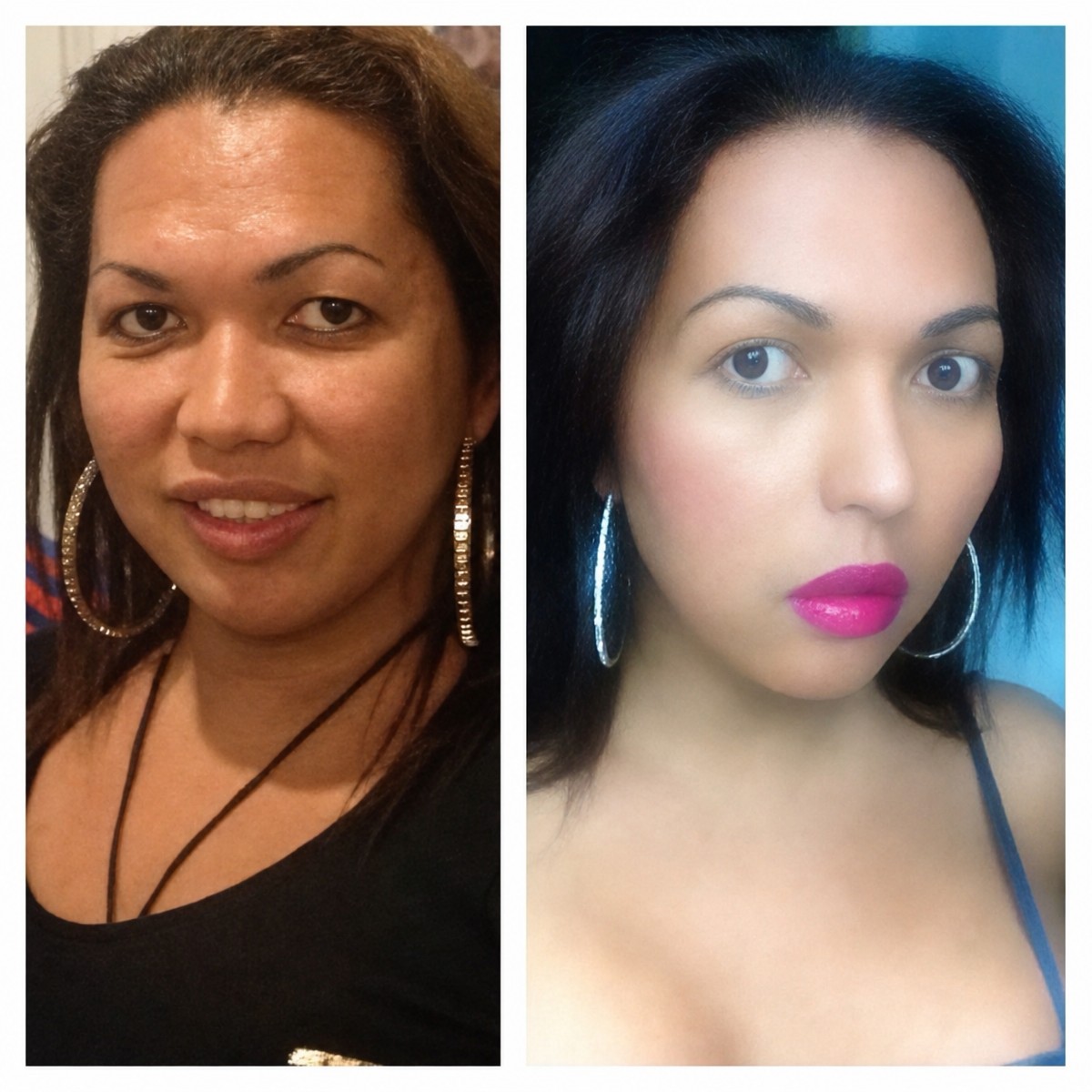 Resultados antes y después de cirugía de feminización facial en Bangkok Plastic Surgery, rasgos suaves