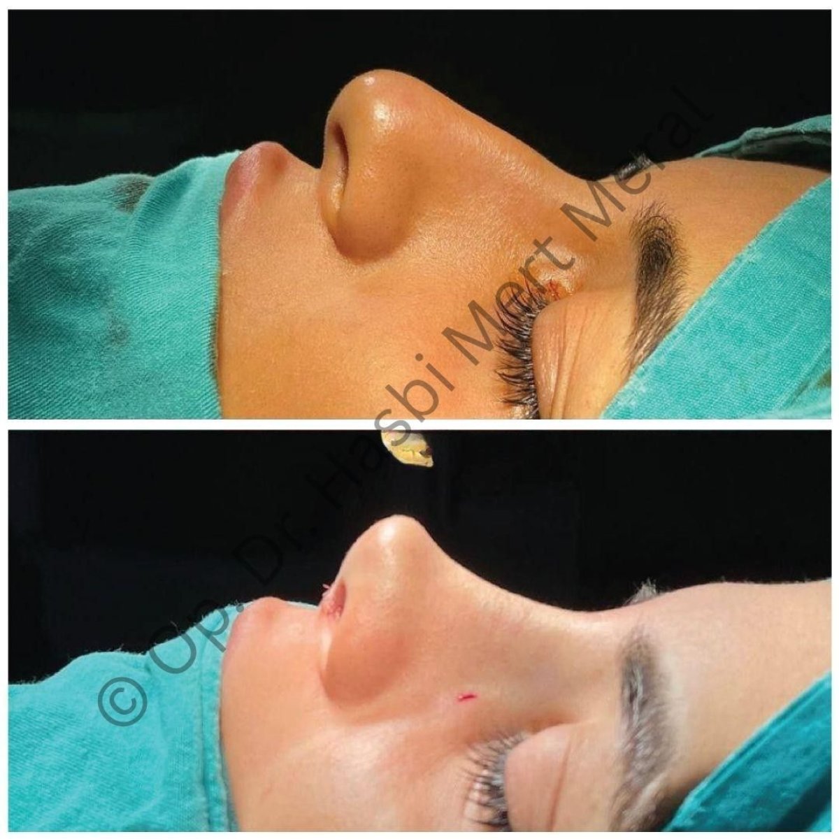 Before and after rhinoplasty results, nose reshaping for improved profile at the clinic