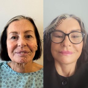 Premium Facelift All Included - photo 5