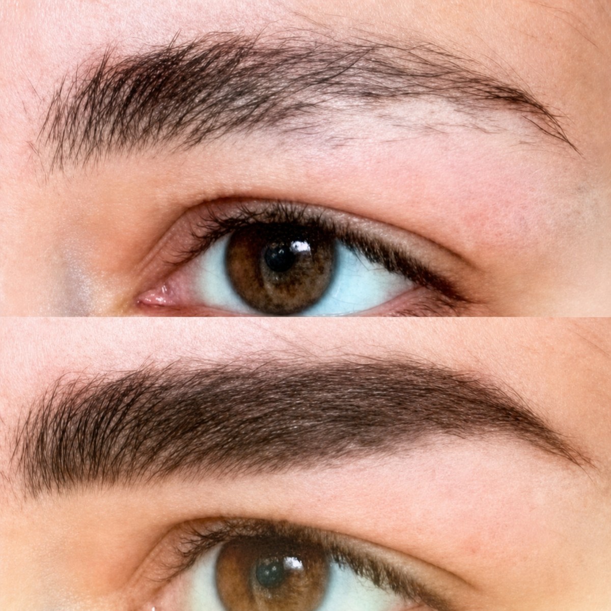 Resultados de trasplante de cejas antes y después en Memorial Bahçelievler Hospital