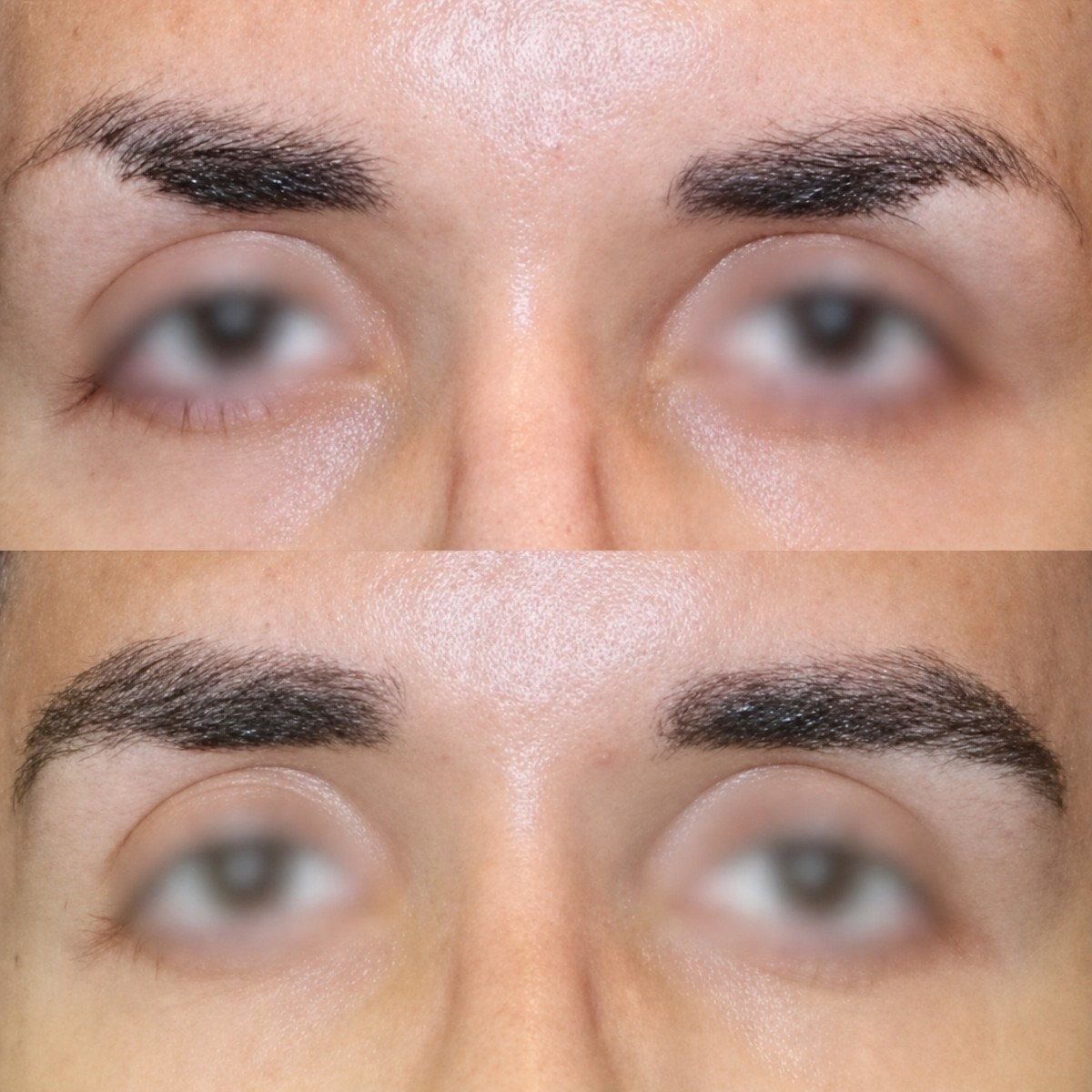 Resultados antes y después de trasplante de cejas en Memorial Bahçelievler Hospital, cejas más densas