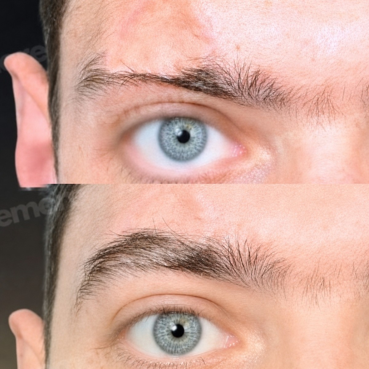 Before and after eyebrow transplantation results at Memorial Bahçelievler Hospital, fuller brows