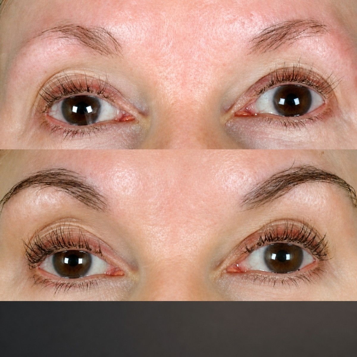 Before and after eyebrow transplantation results at Memorial Bahçelievler Hospital, fuller brows