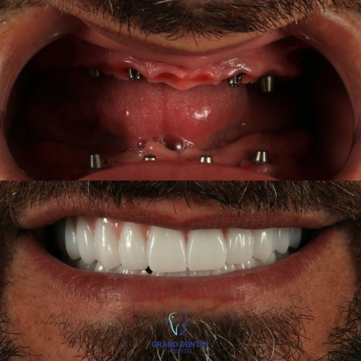Before and after dental implant results at Grand Dental Hospital & Laboratory, restored smile