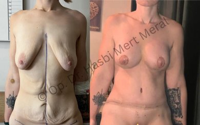 Premium 360 Liposuction All Included - photo 4