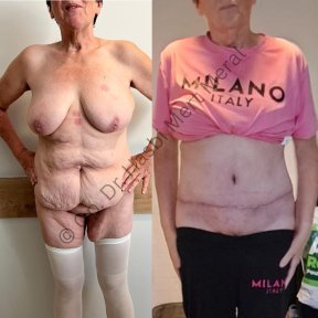 Premium 360 Liposuction All Included - photo 5