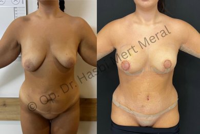Premium 360 Liposuction All Included - photo 6