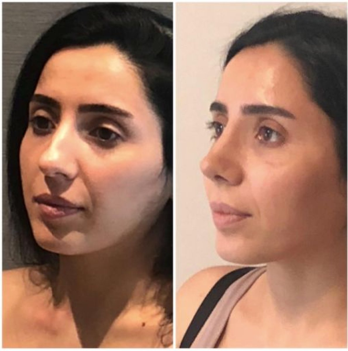 Before and after tip rhinoplasty results at Adem and Havva Medical Center, refined nose shape