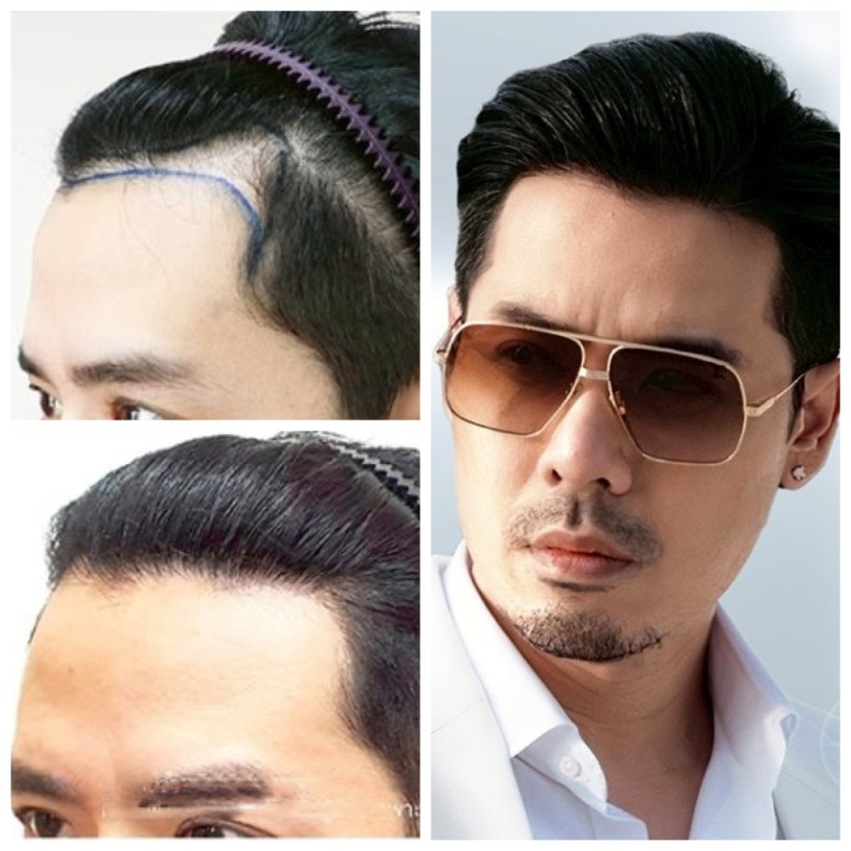 FUE hair transplant before and after results at Dr.Orn Clinic : Medical Hair, restored hairline