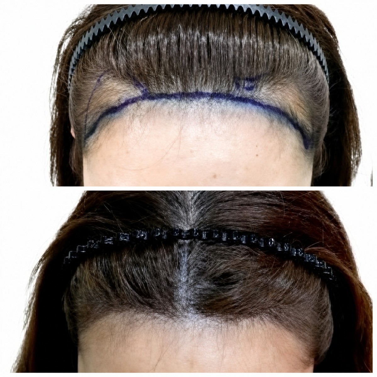 Before and after FUE hair transplant result at Dr.Orn Clinic : Medical Hair, improved hairline