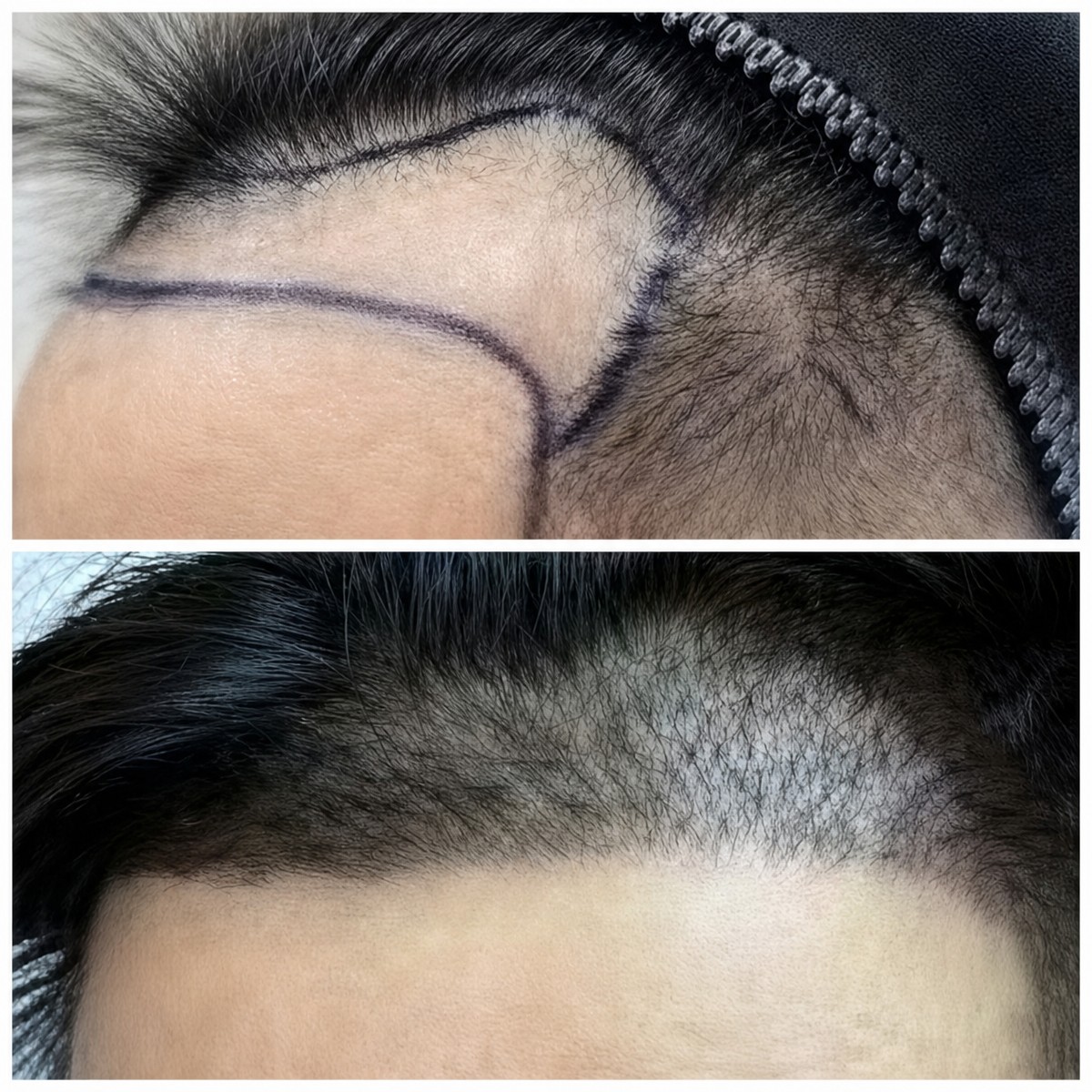 نتائج زراعة الشعر قبل وبعد في Dr.Orn Clinic : Medical Hair، خط شعر محسن