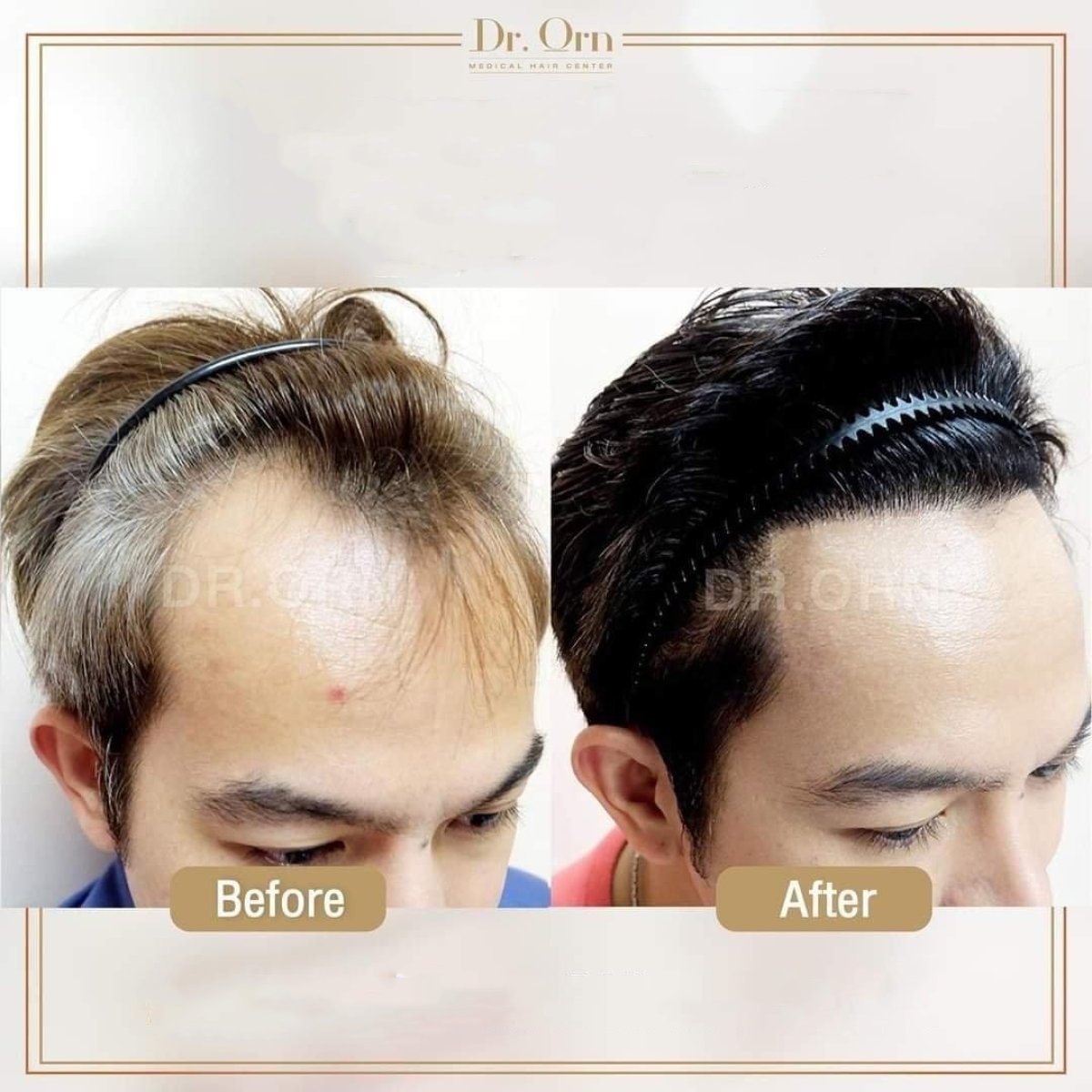 Efekty przeszczepu włosów przed i po w Dr.Orn Clinic : Medical Hair, odbudowana linia