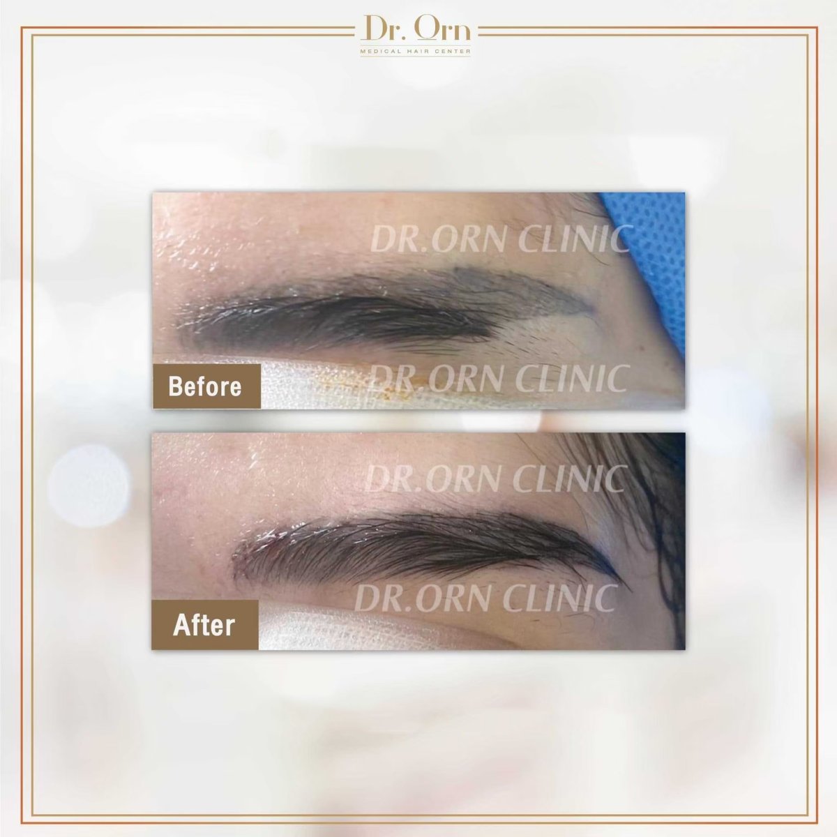 Résultat avant et après greffe de sourcils à Dr.Orn Clinic : Medical Hair, sourcils plus fournis