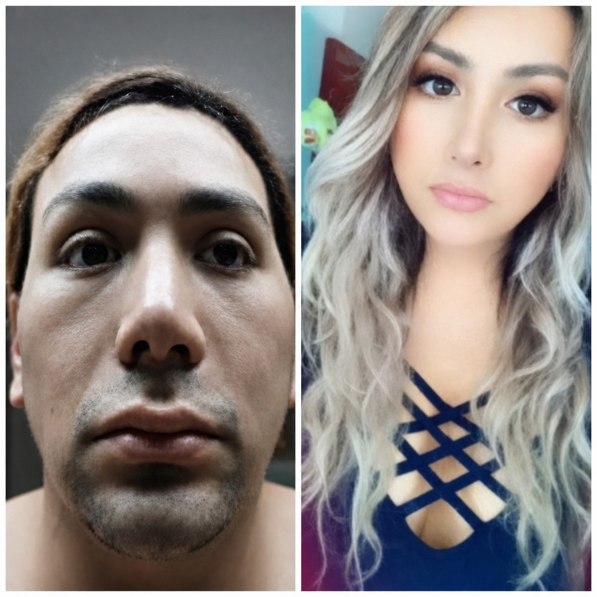 Resultados de cirugía de feminización facial antes y después en Bangkok Plastic Surgery, rasgos suaves