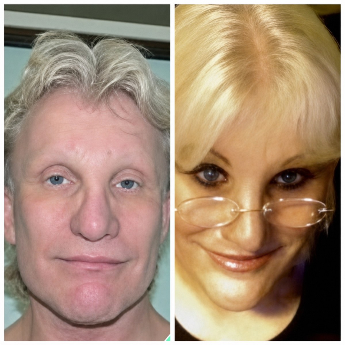 Resultados de cirugía de feminización facial antes y después en Bangkok Plastic Surgery, FFS