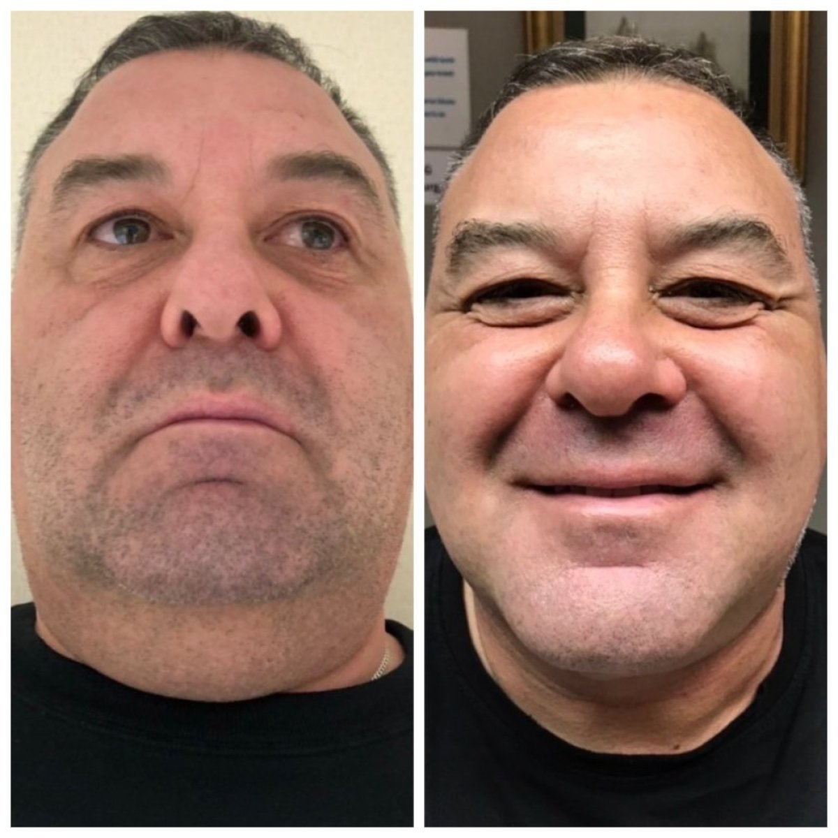 Результаты липосакции до и после в Bangkok Plastic Surgery, улучшенный контур подбородка