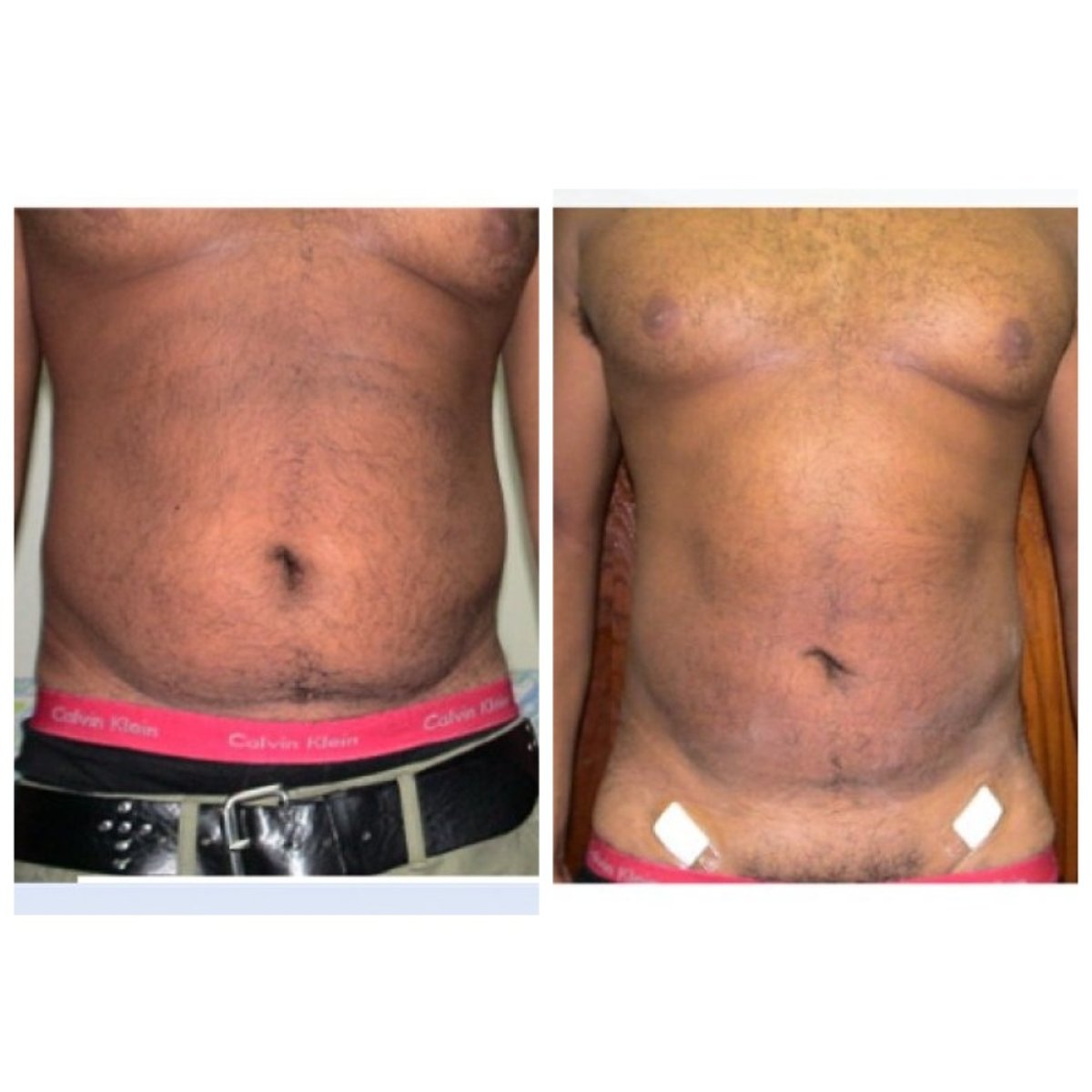 Before and after liposuction results at Bangkok Plastic Surgery, visible abdominal contouring