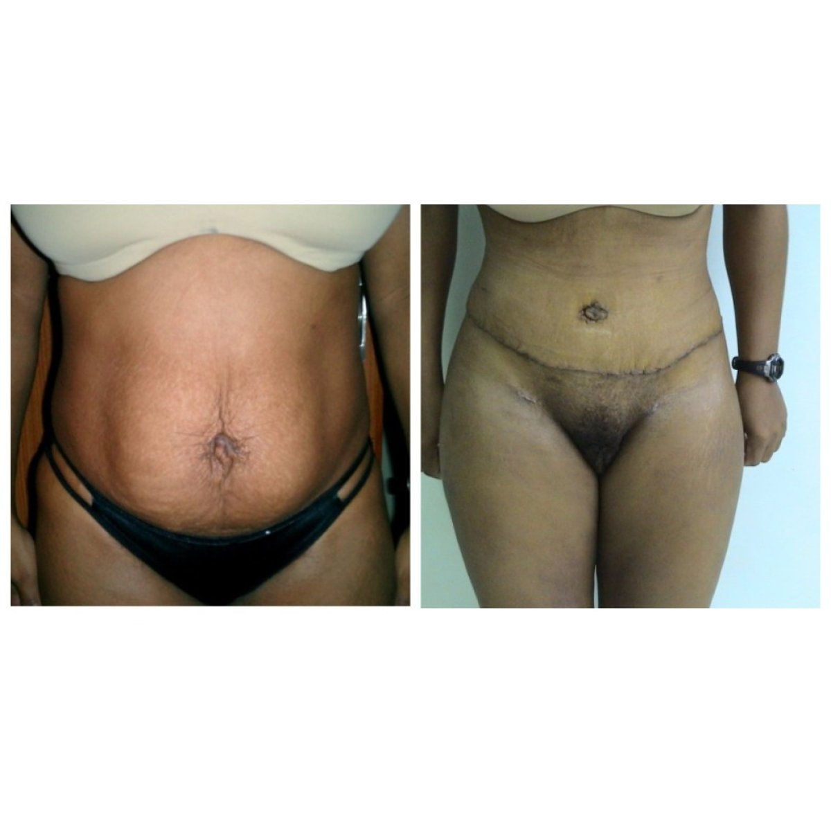 نتائج شد البطن قبل وبعد في عيادة Bangkok Plastic Surgery، تحسين شكل البطن