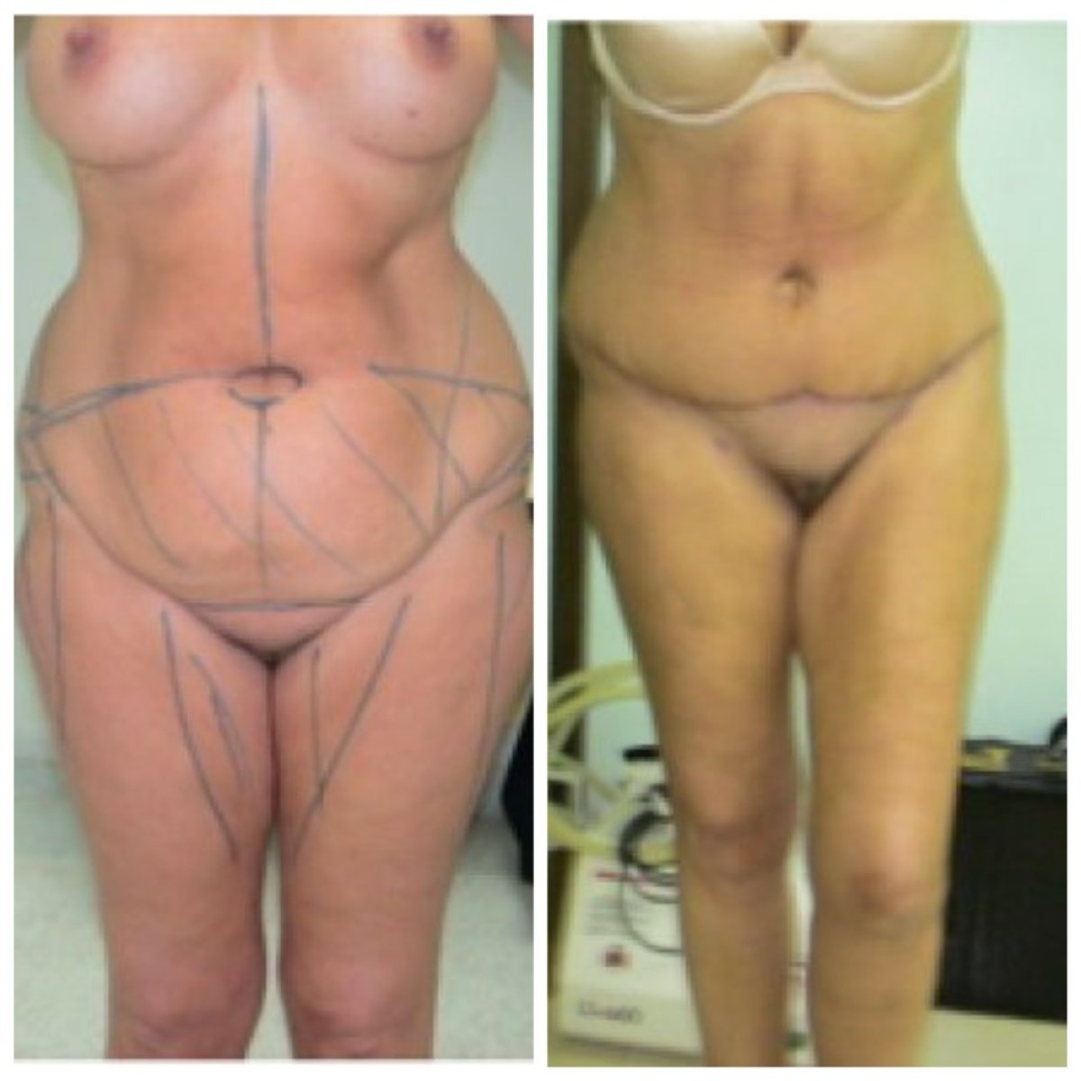 نتائج شد البطن قبل وبعد في عيادة Bangkok Plastic Surgery، تحسين شكل البطن