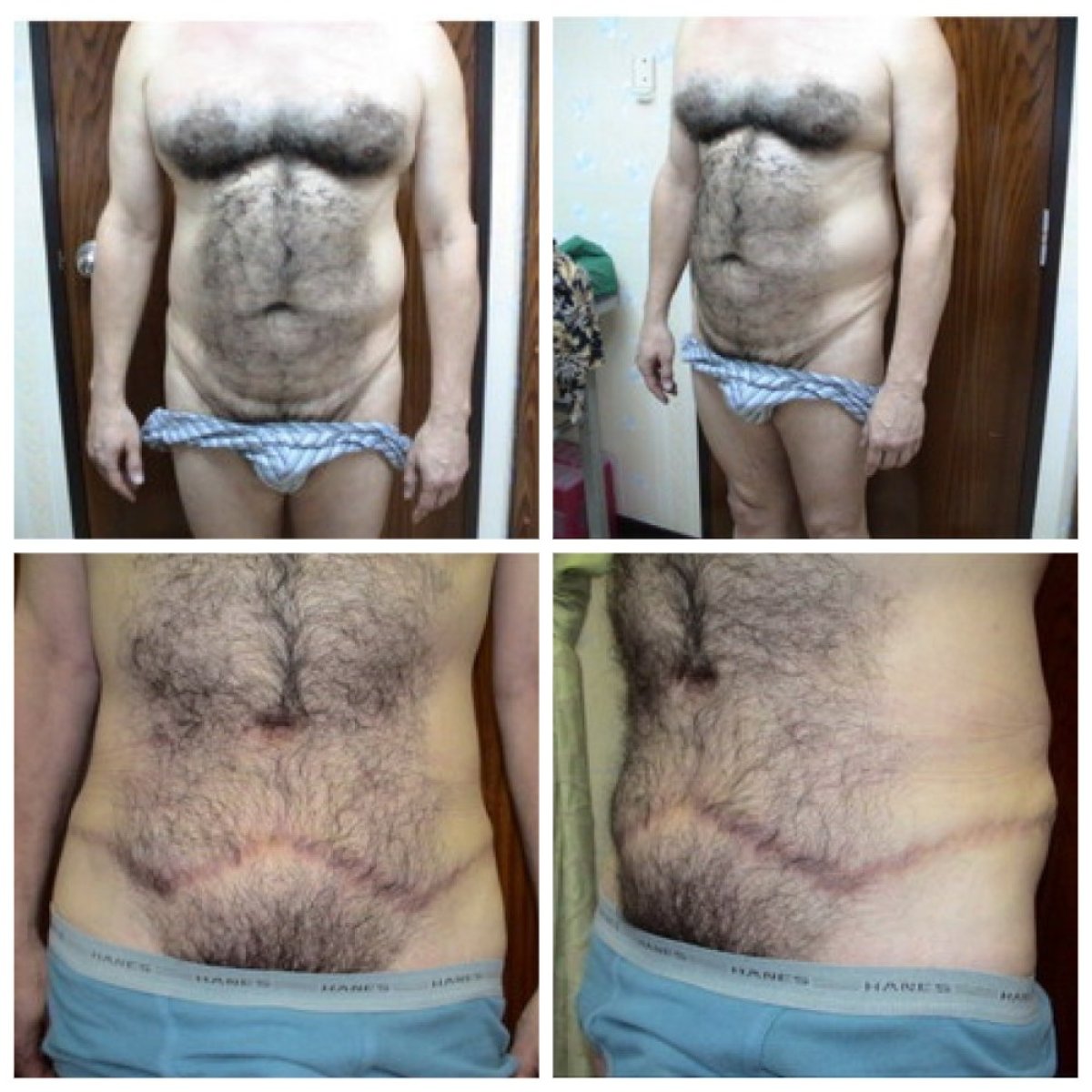 Before and after tummy tuck results for male patient at Bangkok Plastic Surgery clinic