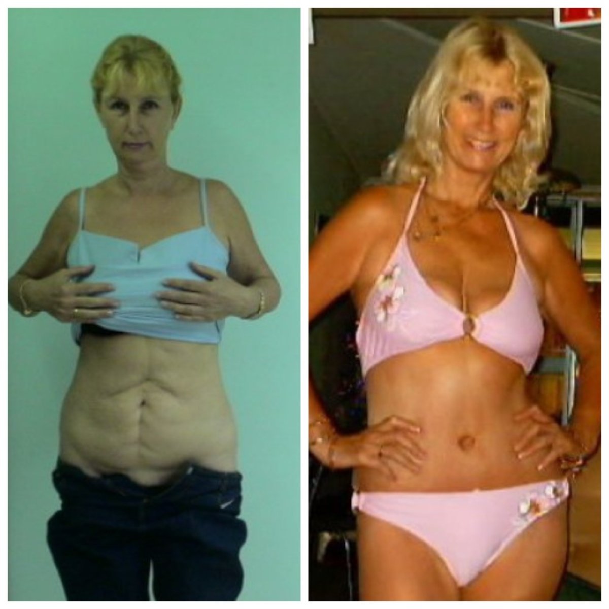نتائج شد البطن قبل وبعد في عيادة Bangkok Plastic Surgery – تحسين شكل البطن