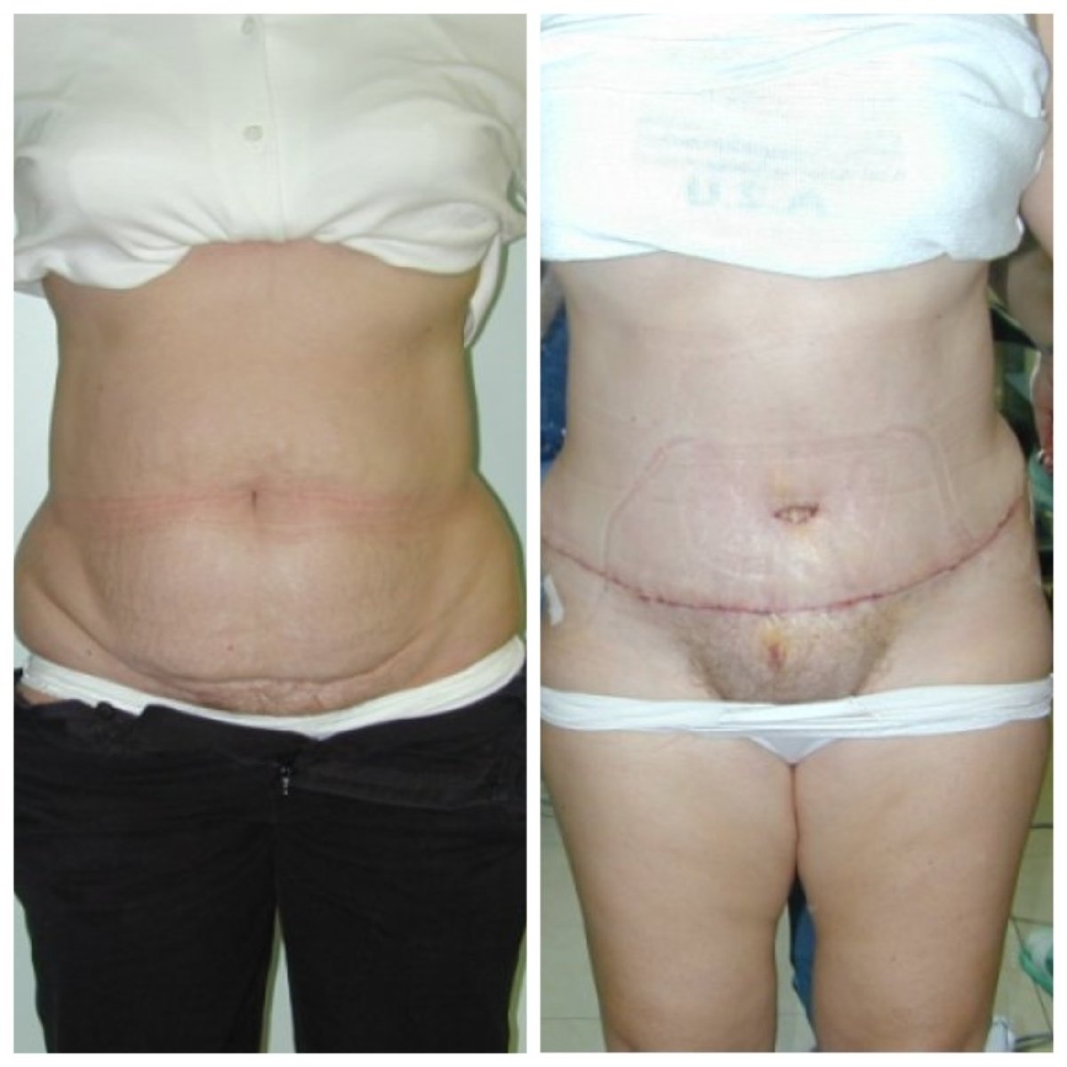 Before and after tummy tuck results at Bangkok Plastic Surgery, improved abdominal contour