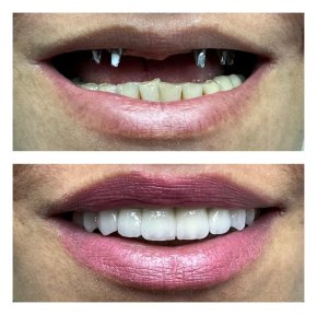 All-on-6 Implants with Straumann for Permanent Tooth Replacement — 4★ Hotel, 9 Nights - photo 5