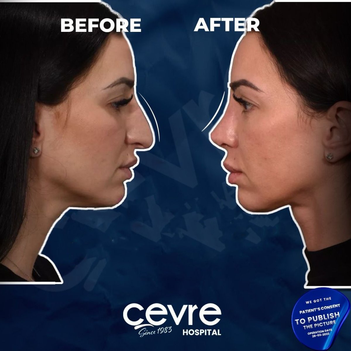 Résultats avant et après rhinoplastie à Adem and Havva Medical Center, profil du nez amélioré