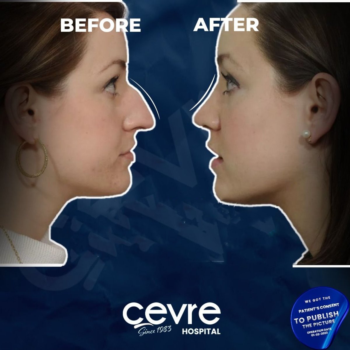 Résultats avant et après rhinoplastie à Cevre Hospital, amélioration visible du nez