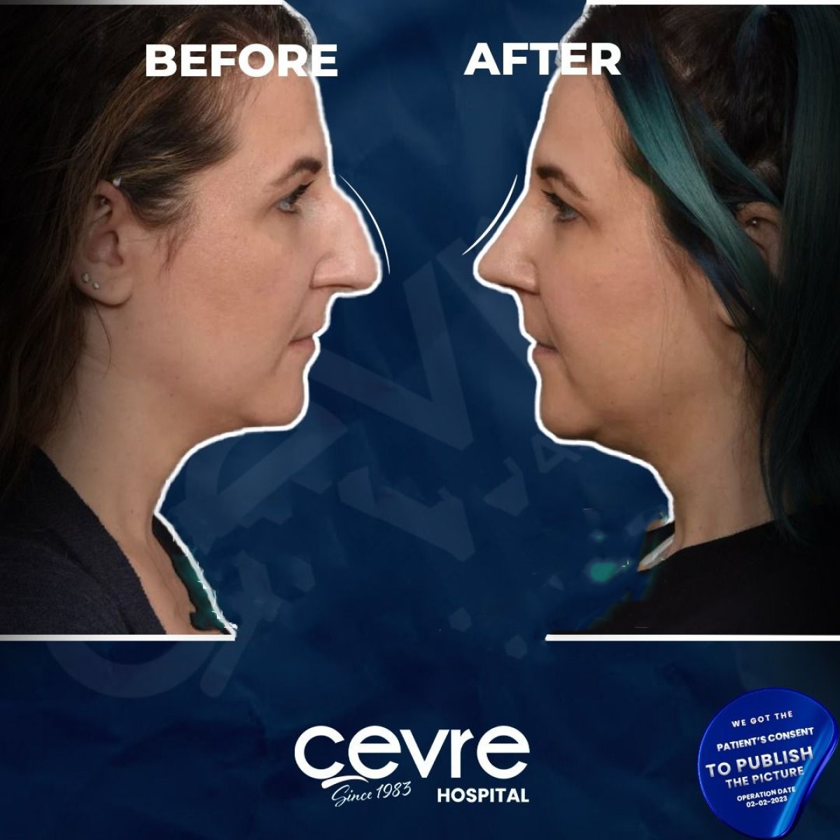 نتائج عملية تجميل الأنف قبل وبعد في Adem and Havva Medical Center، تحسين شكل الأنف