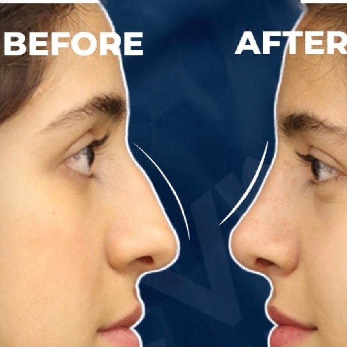 نتائج عملية تجميل الأنف قبل وبعد في Adem and Havva Medical Center، تحسين شكل الأنف