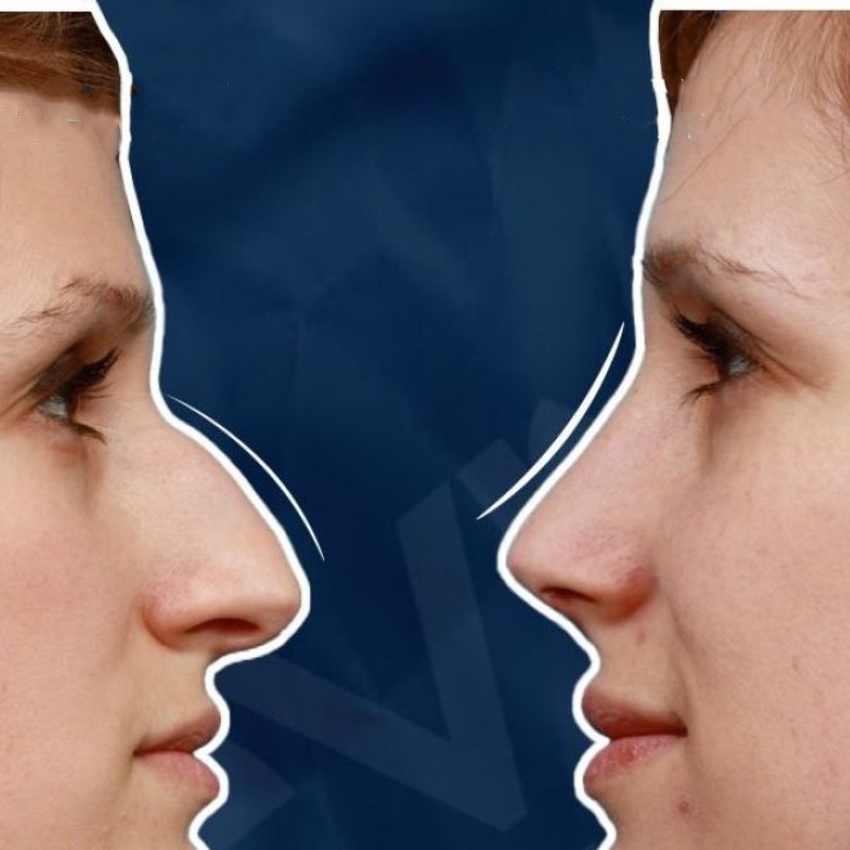 Resultados de rinoplastia antes y después en Adem and Havva Medical Center, remodelación nasal