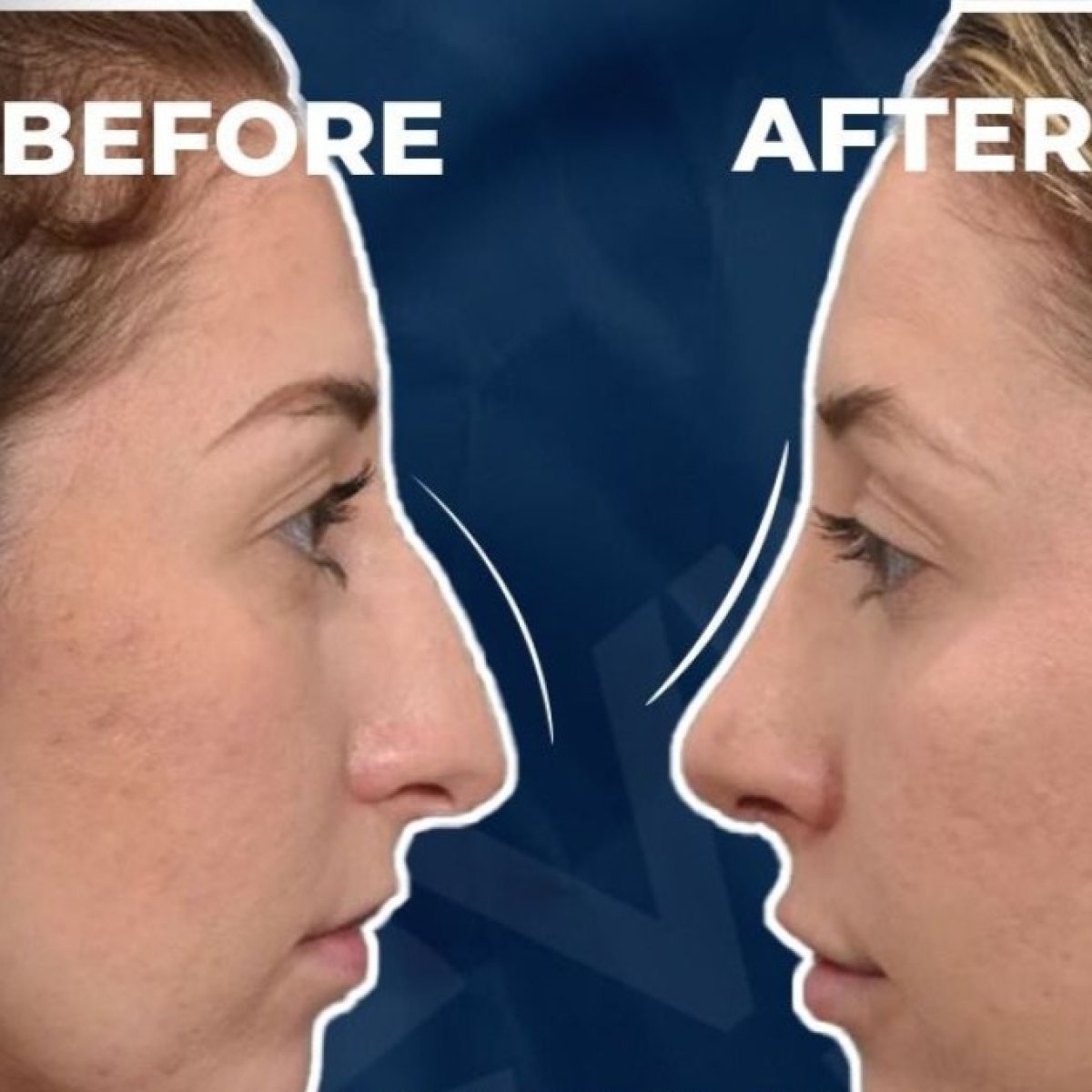 Résultats avant et après rhinoplastie à Adem and Havva Medical Center, remodelage du nez