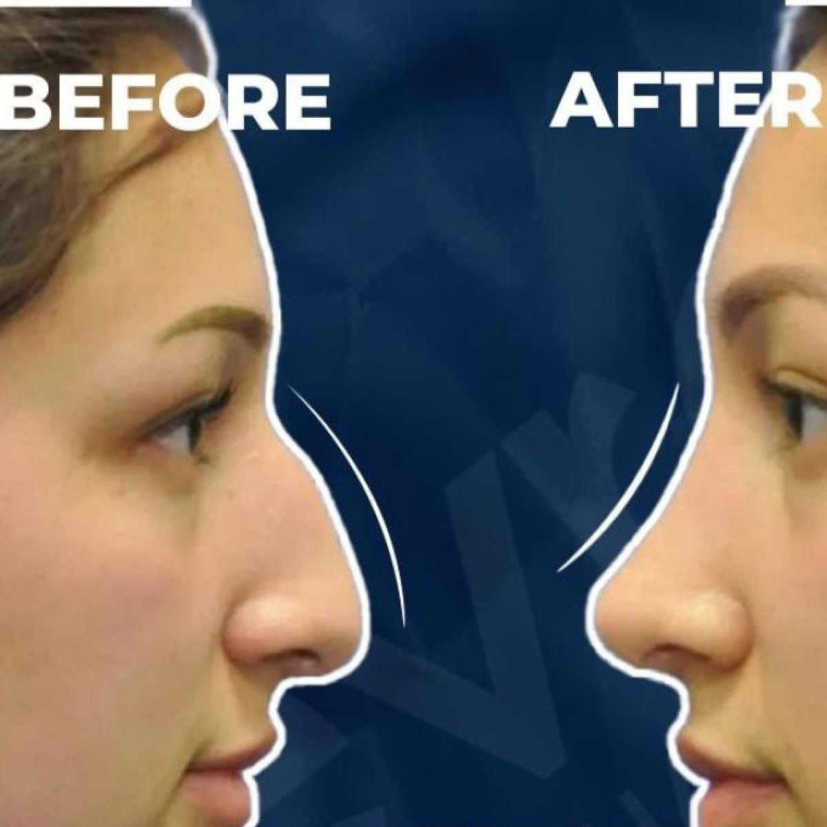 نتائج عملية تجميل الأنف قبل وبعد في Adem and Havva Medical Center، تحسين شكل الأنف