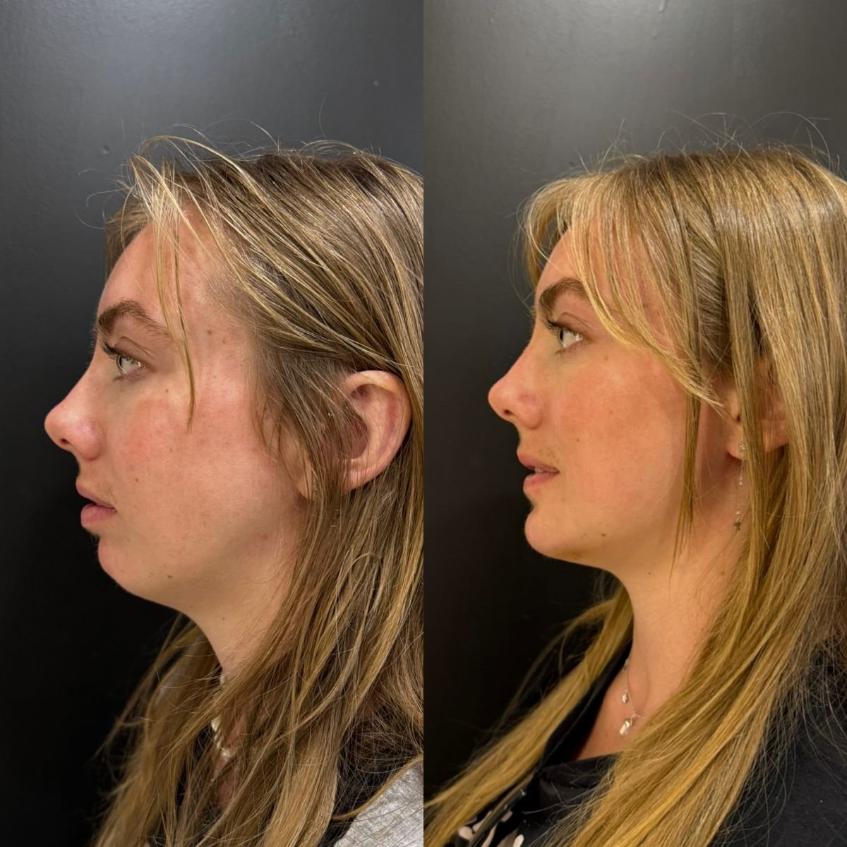 نتيجة قبل وبعد إزالة دهون الخد في عيادة Dr. Alexandro Aguilera - Plastic Surgery