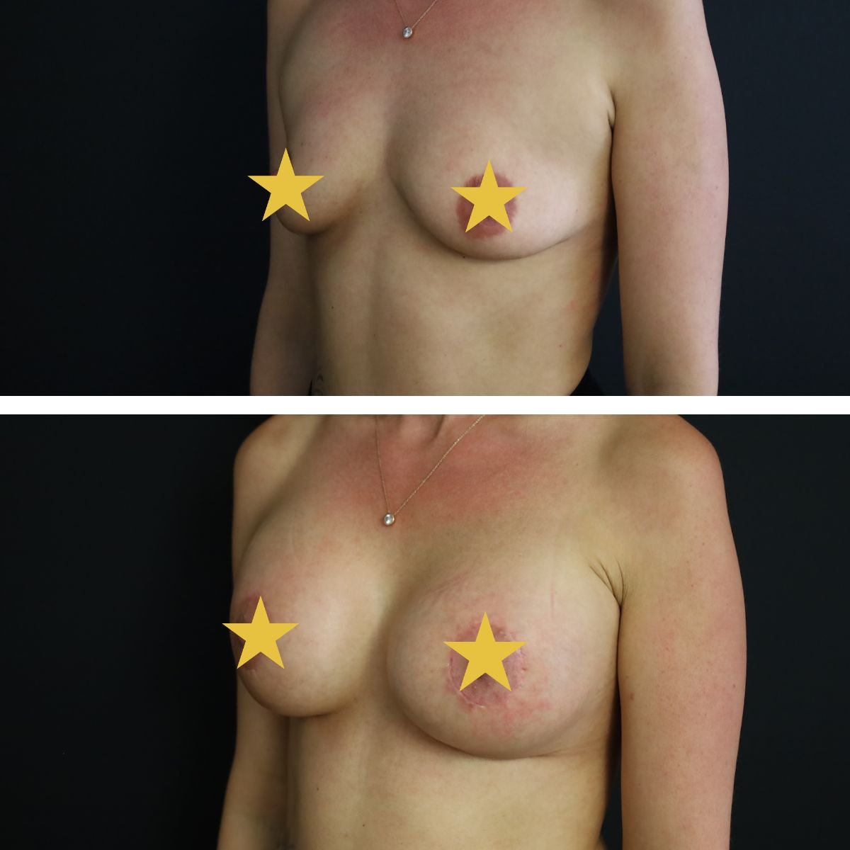Résultats avant et après augmentation mammaire à Esthétique du Nord, volume des seins accru