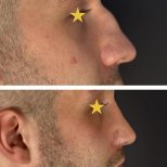 Fotos vor und nach Rhinoplastik (Nasenkorrektur) durch Dr. Walid Eljabu