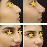 Fotos vor und nach Rhinoplastik (Nasenkorrektur) durch Dr. Walid Eljabu