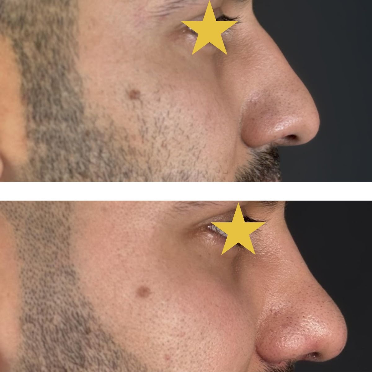 Before and after rhinoplasty results at Esthétique du Nord, improved nose profile for men