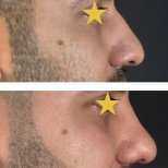 Fotos vor und nach Rhinoplastik (Nasenkorrektur) durch Dr. Walid Eljabu