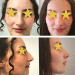 Fotos vor und nach Rhinoplastik (Nasenkorrektur) durch Dr. Walid Eljabu