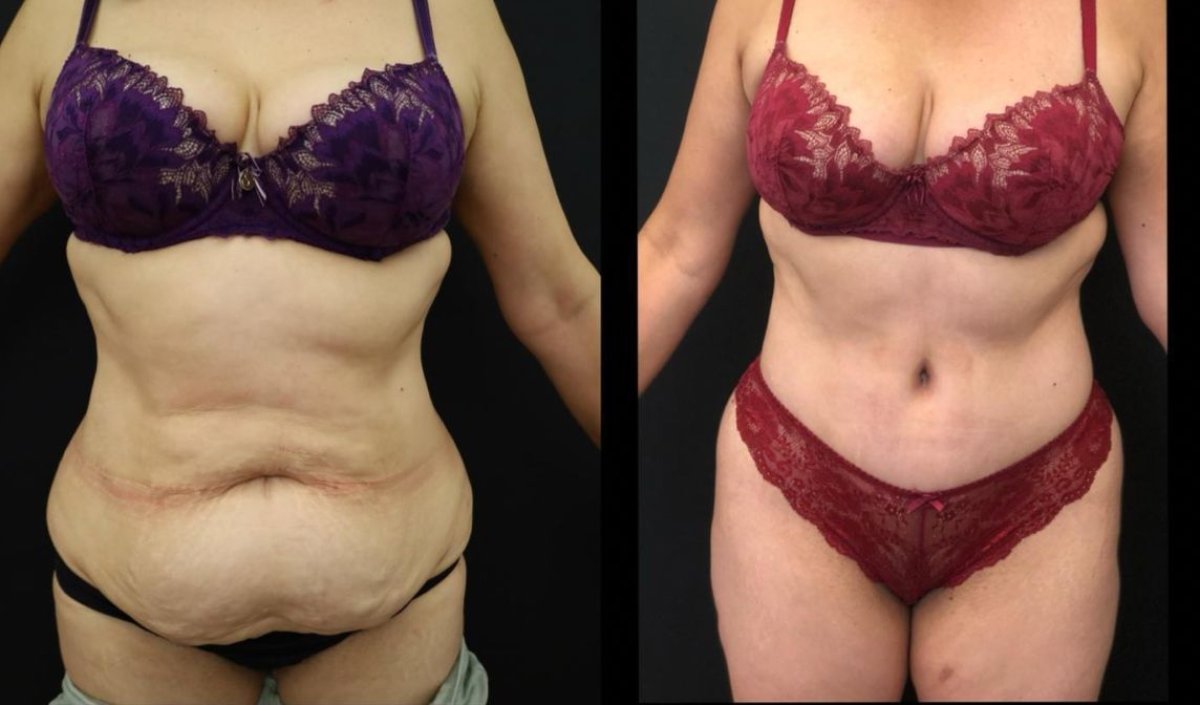Resultados de abdominoplastia antes y después en Esthétique du Nord – contorno abdominal mejorado