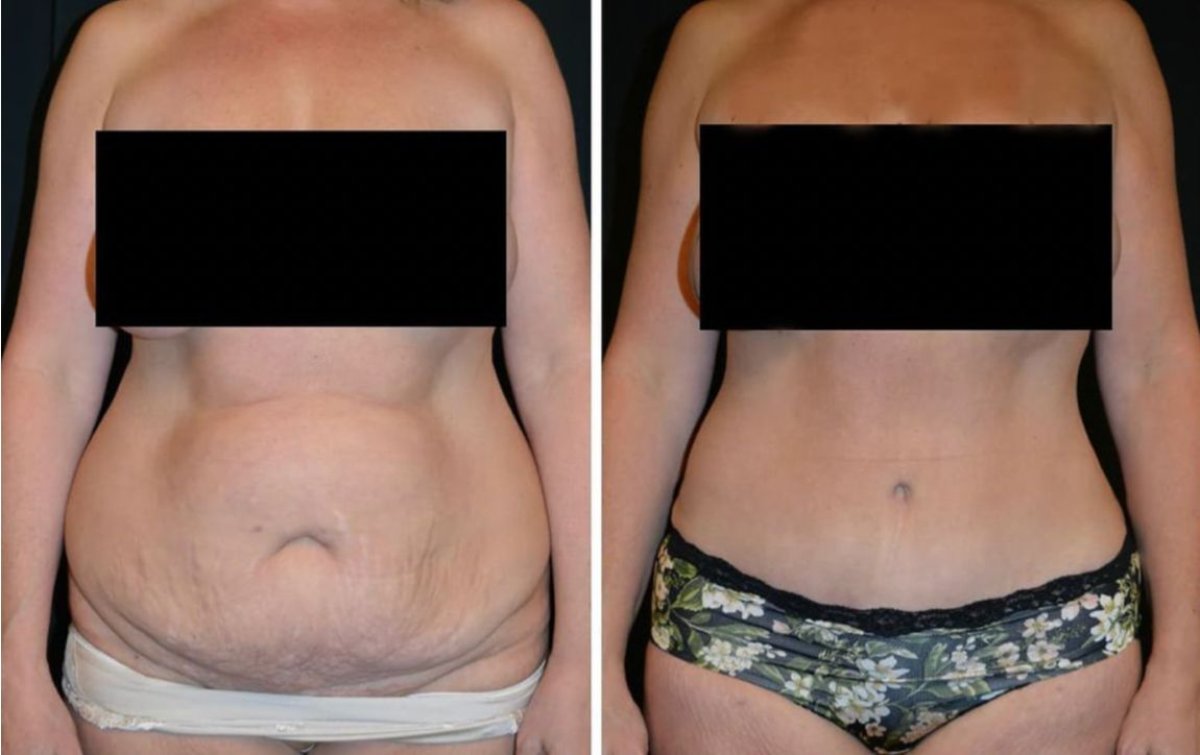 Resultados de abdominoplastia antes y después en Esthétique du Nord – abdomen mejorado