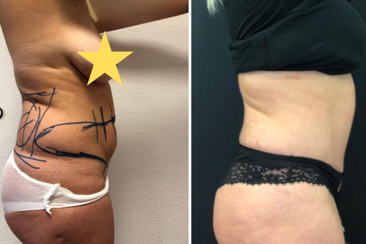 Resultados de abdominoplastia antes y después en Esthétique du Nord – mejora del contorno abdominal
