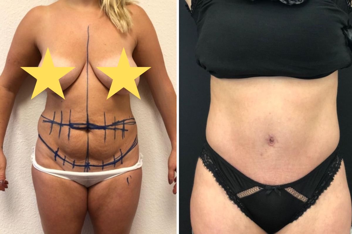 Resultados de abdominoplastia antes y después en Esthétique du Nord, mejora del contorno abdominal