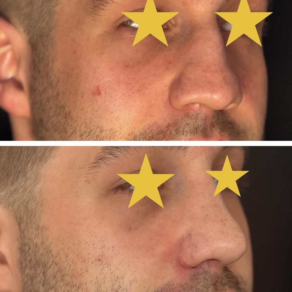 Before and after revision rhinoplasty results at Esthétique du Nord, improved nose contour