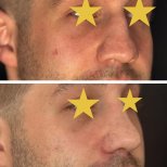Fotos vor und nach Rhinoplastik (Nasenkorrektur) durch Dr. Walid Eljabu